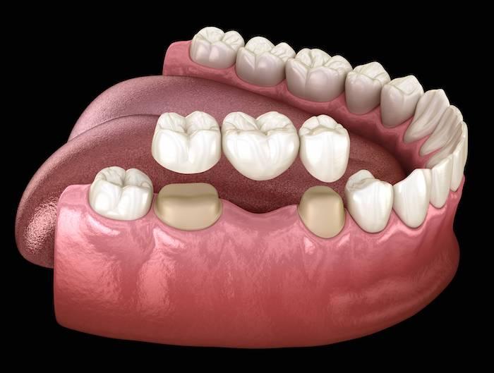 An illustration of a dental bridge