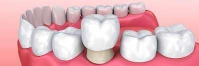 An illustration of a dental crown