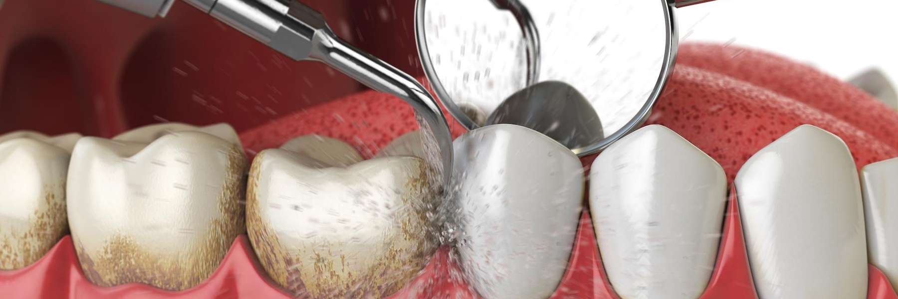 An illustration of a dental cleaning