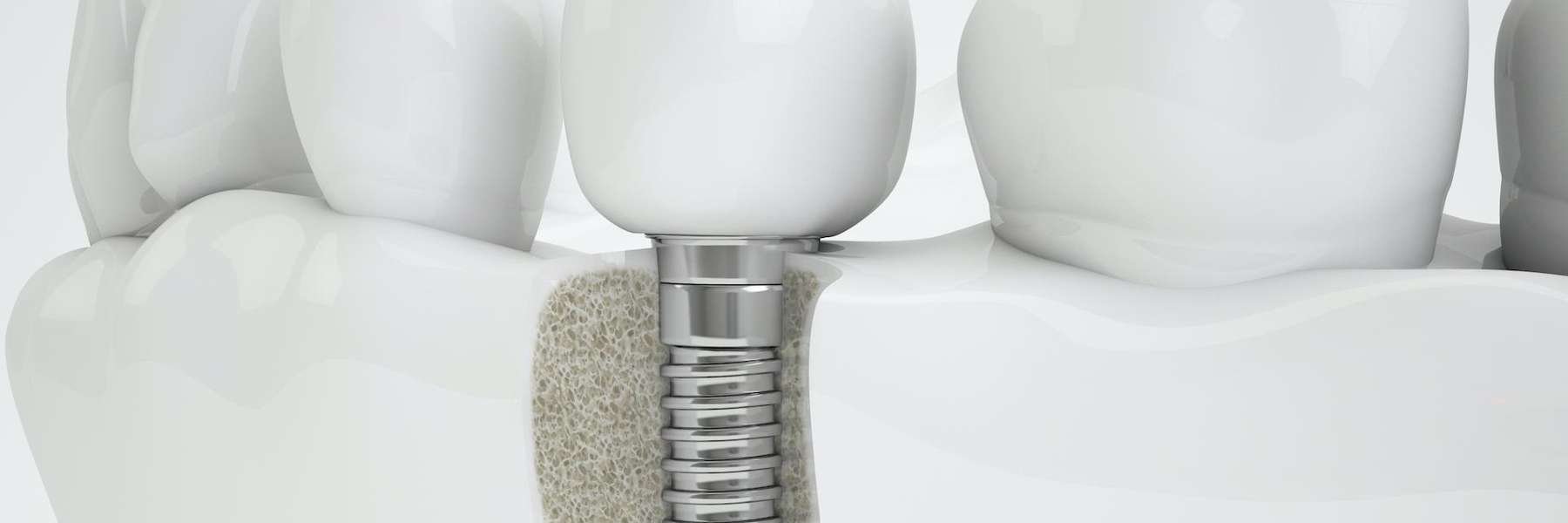 An illustration of a dental implant and screw in a jaw bone