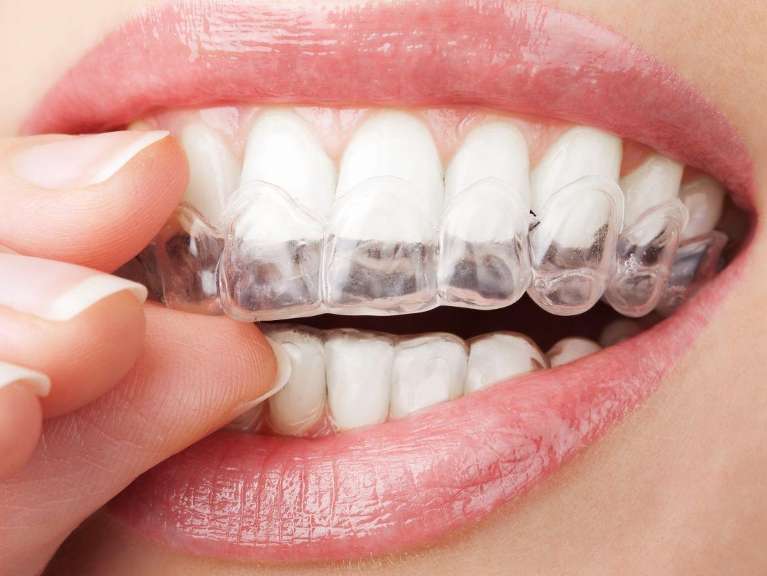A woman putting in her Invisalign tray | Invisalign Corona CA