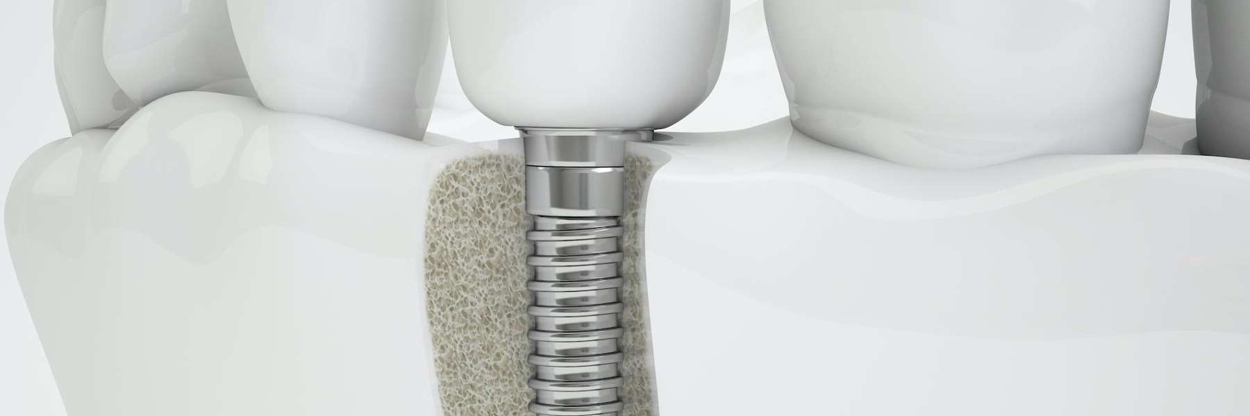 An illustration of a dental implant in the mouth