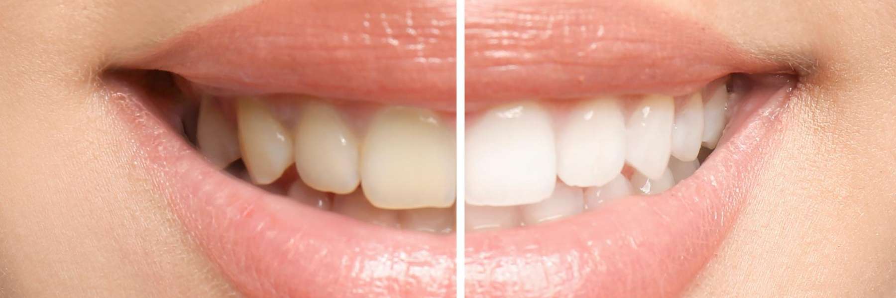Before and after teeth whitening comparison