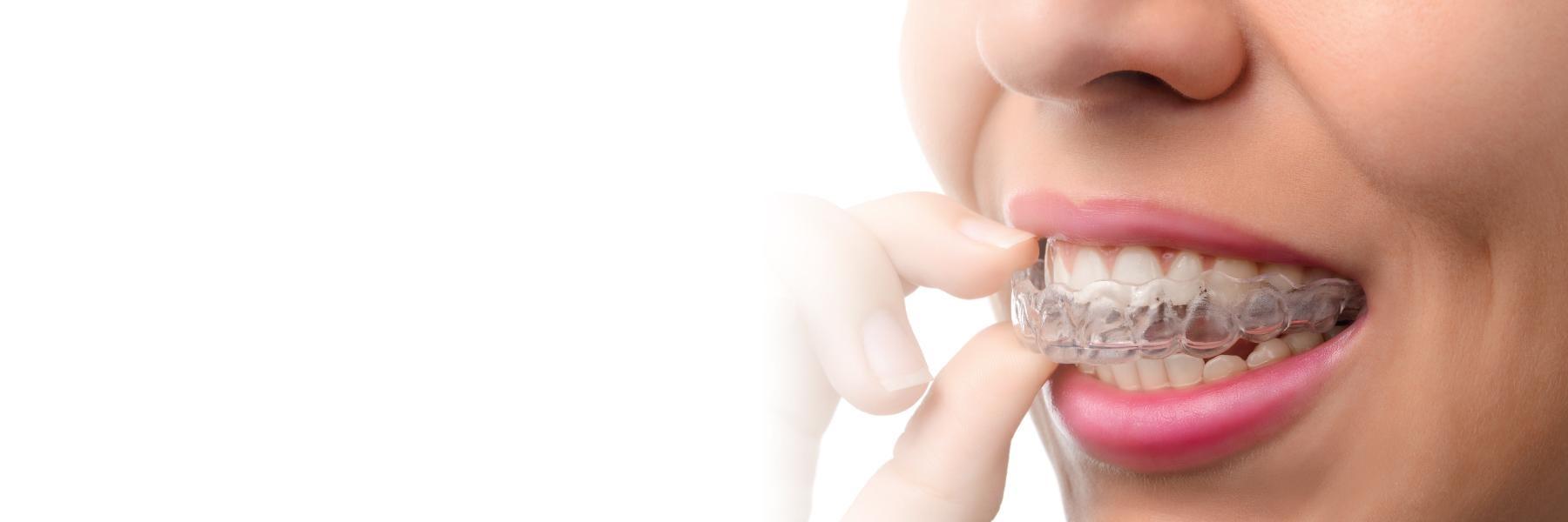 Invisalign clear braces are available in Corona, CA