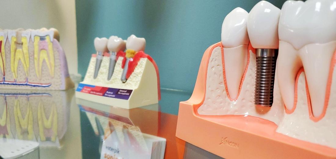 Diagrams of teeth and dental implants at Dental Care of Corona